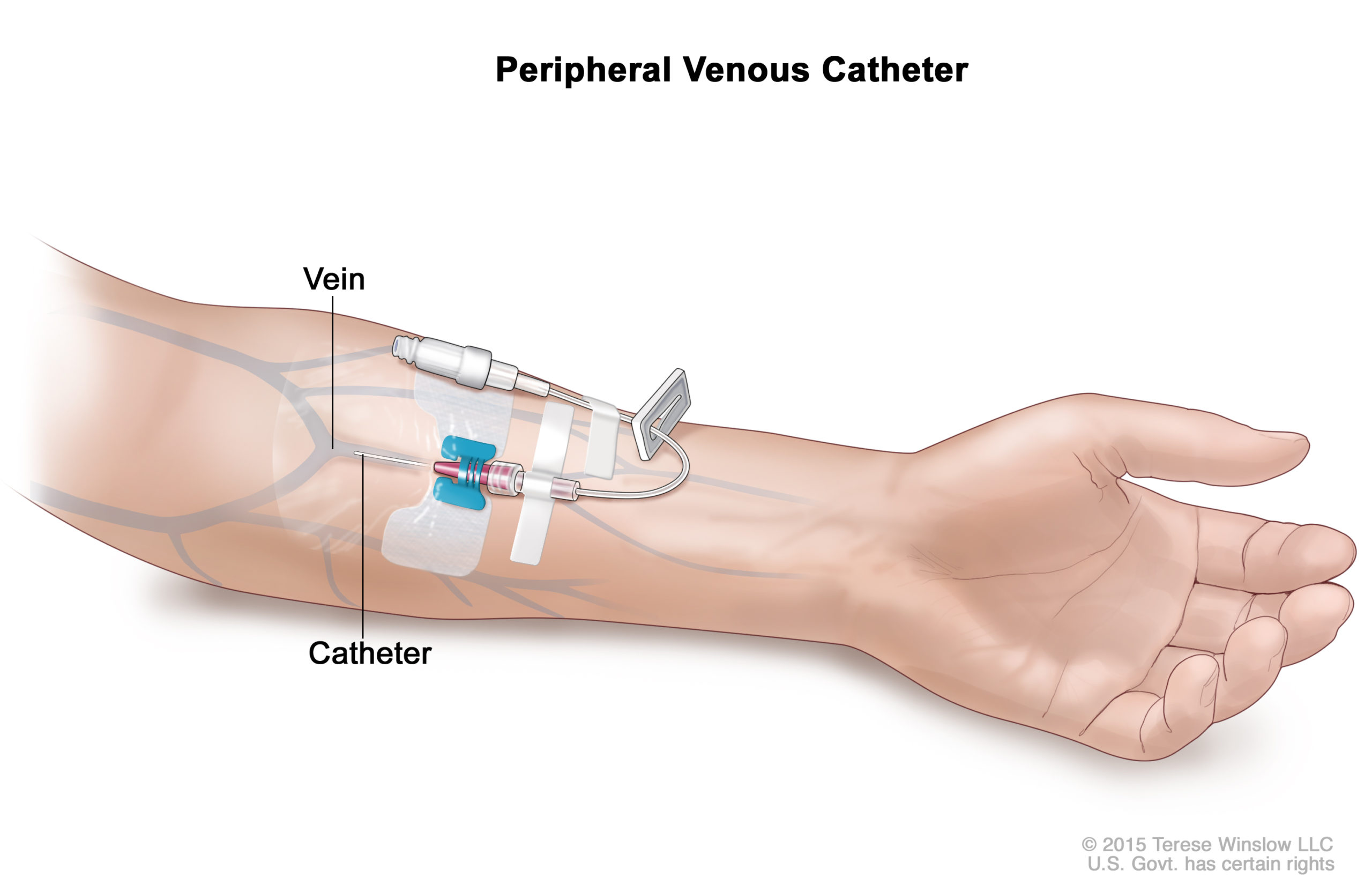 peripheral-venous-catheter-leejeonghwan